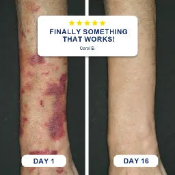 🏆Official US Store🔥TopSpire® Bruise Repair & Skin-Strengthening Cream